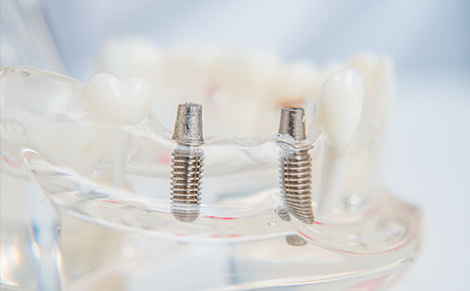 Model of dental implants